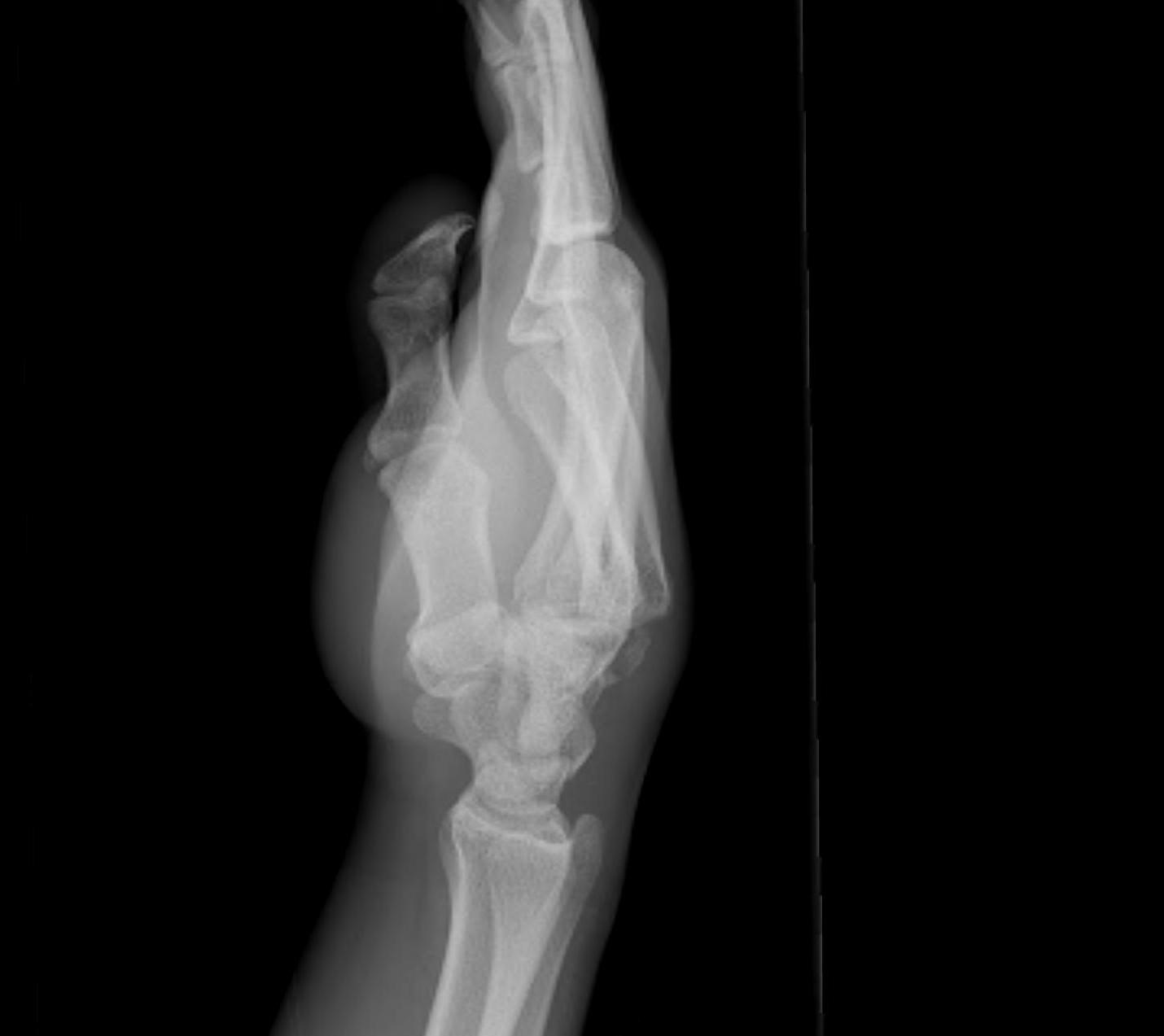 Metacarpal Base Fracture Dislocation Lateral